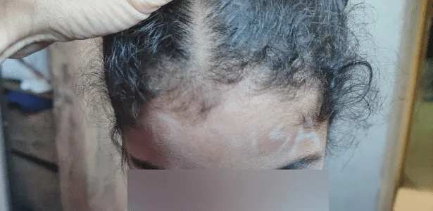 Mãe diz que educadora escreveu 'boba' na testa da filha no interior de SP
