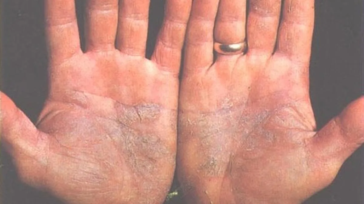 Psoriasis cases are on the rise, say dermatologists. What are the causes and how do you treat the condition?