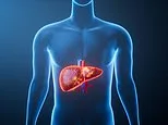Warning over staggering five-fold surge in deadly liver disease that's 'underdiagnosed' - experts reveal red flags to watch out for