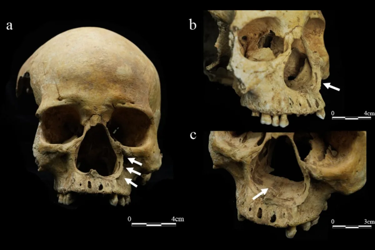 This Skeleton May Prove That Imperial China Really Did Cut Off Noses as Punishment