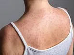 Teen dies of measles-related brain complication... as cases continue to surge to record levels