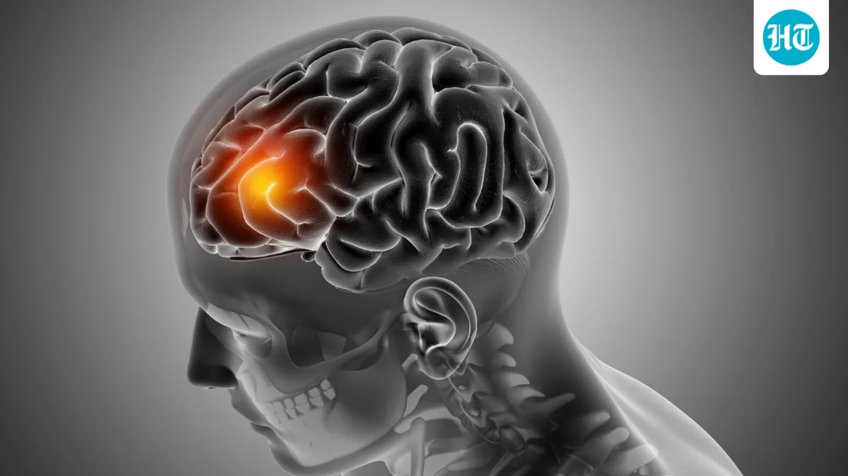 Why are strokes rising among young adults? Neurosurgeon shares 5 warning signs