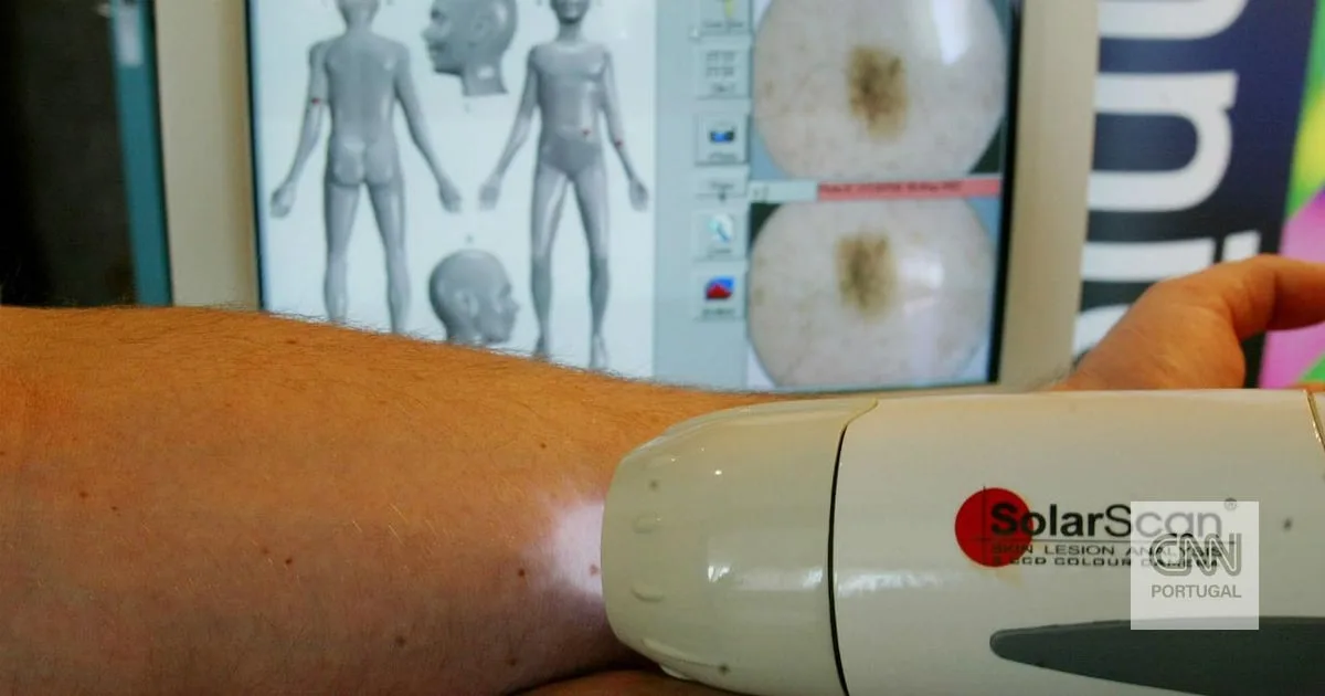 Farmacêuticas anunciam "resultados positivos" na última fase dos ensaios clínicos da vacina contra o melanoma