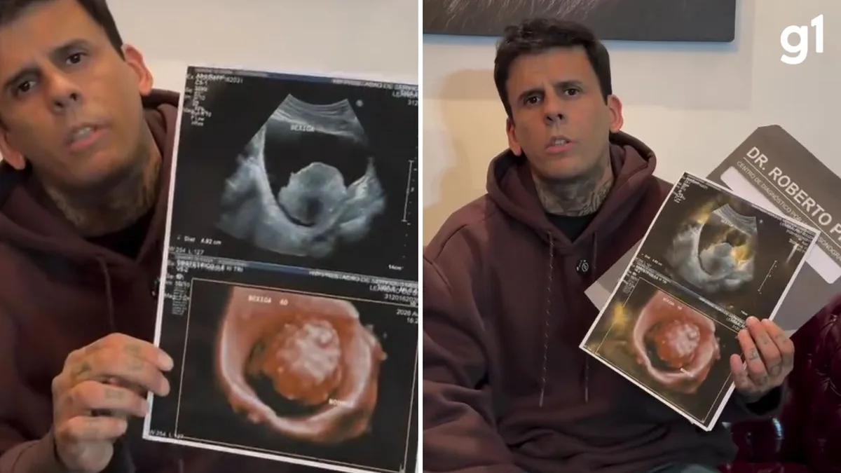 Saiba como responsável por remoção de tatuagens do 'homem mais tatuado do Brasil' descobriu tumor momentos antes de sessão