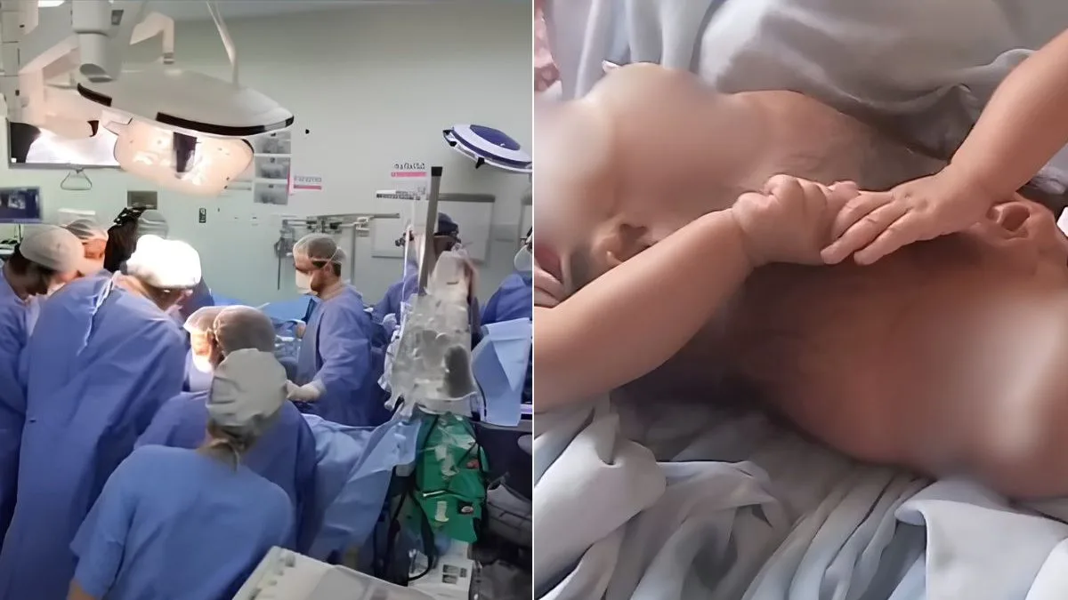 Após 15 horas de cirurgia, morrem gêmeas siamesas que nasceram unidas pela cabeça