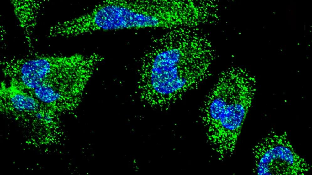 Científicos del CONICET identificaron un mecanismo que podría favorecer la resistencia del cáncer de páncreas