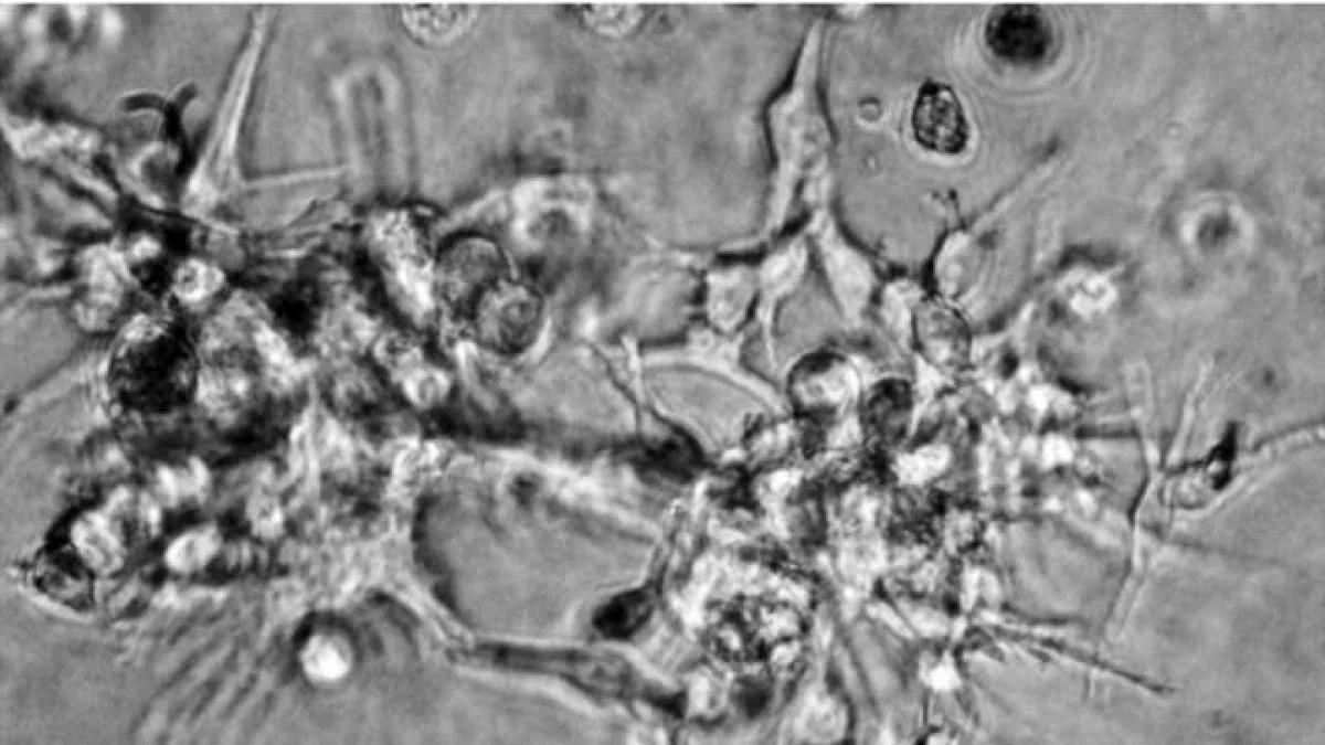 Moderna y Merck anuncian prometedores avances en una vacuna contra el melanoma