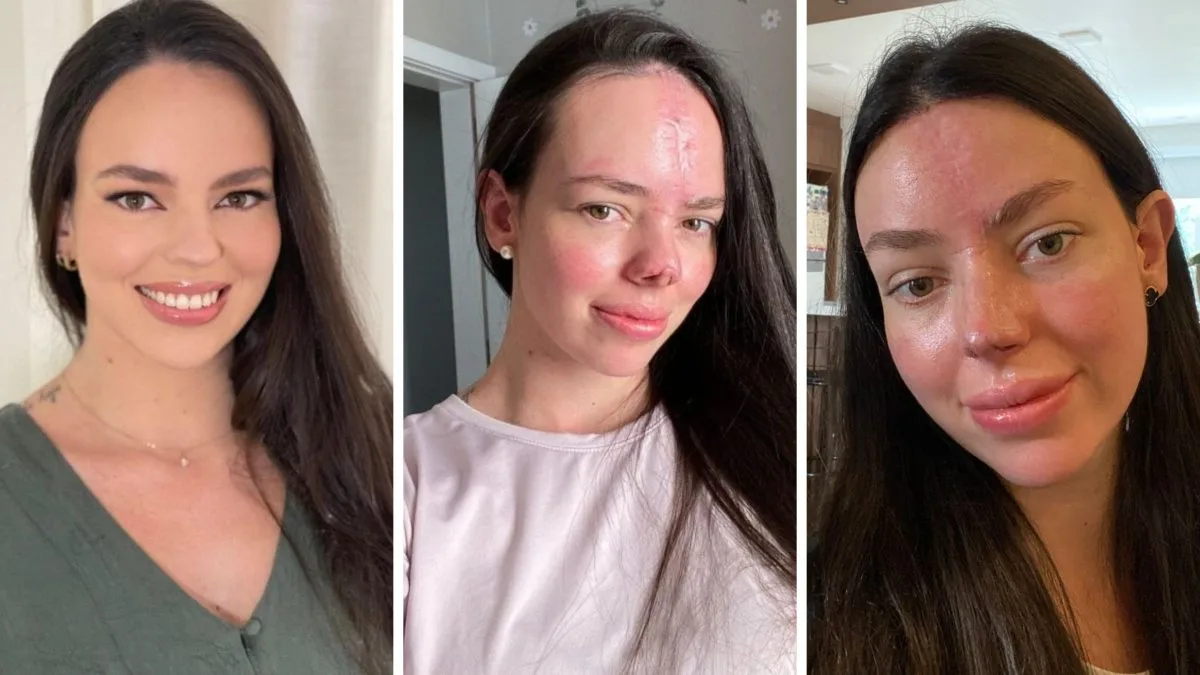 ‘Voltei a me reconhecer’: doula mostra resultado de reconstrução facial sete meses após acidente grave em SC