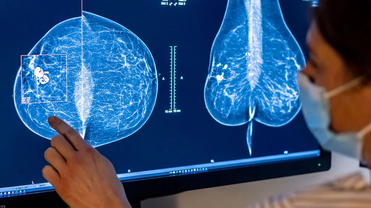Krankenkassen: Brustkrebs-Früherkennung schon ab 45 Jahren