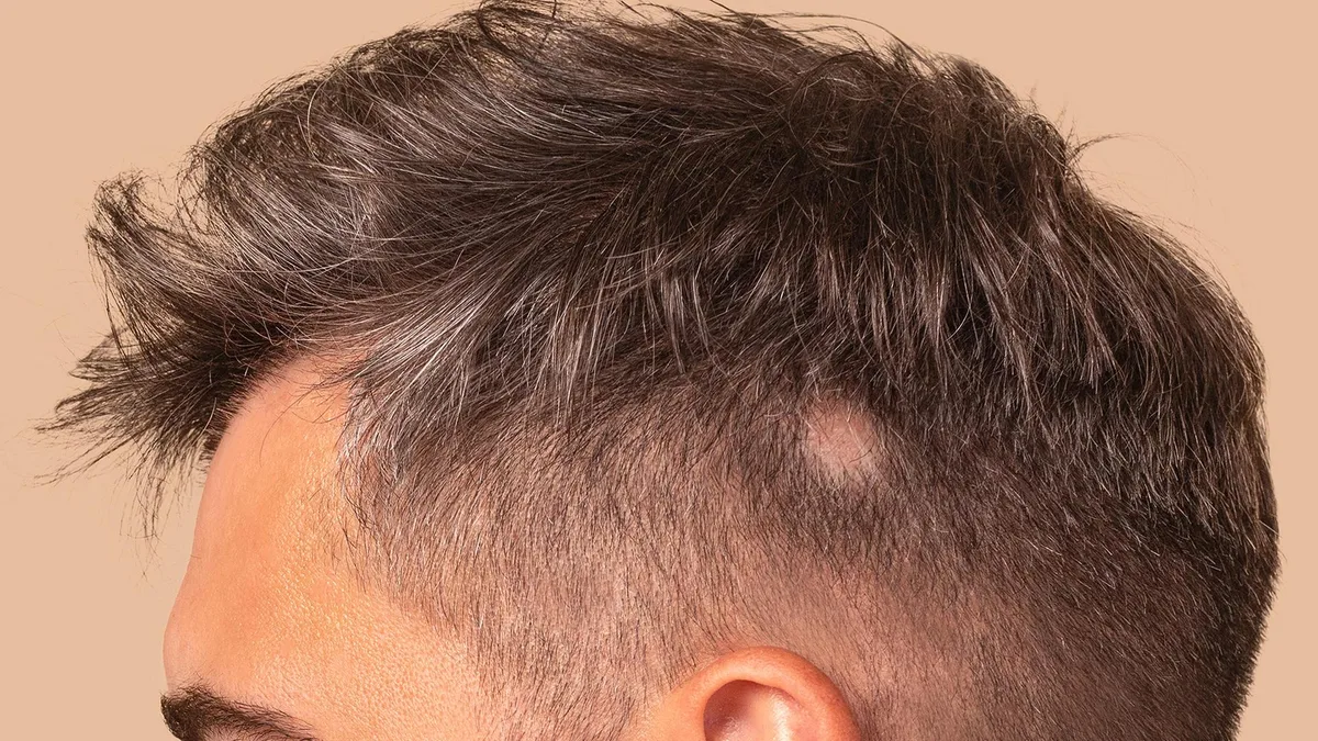 Kreisrunder Haarausfall: Ursache, Behandlung und Verlauf