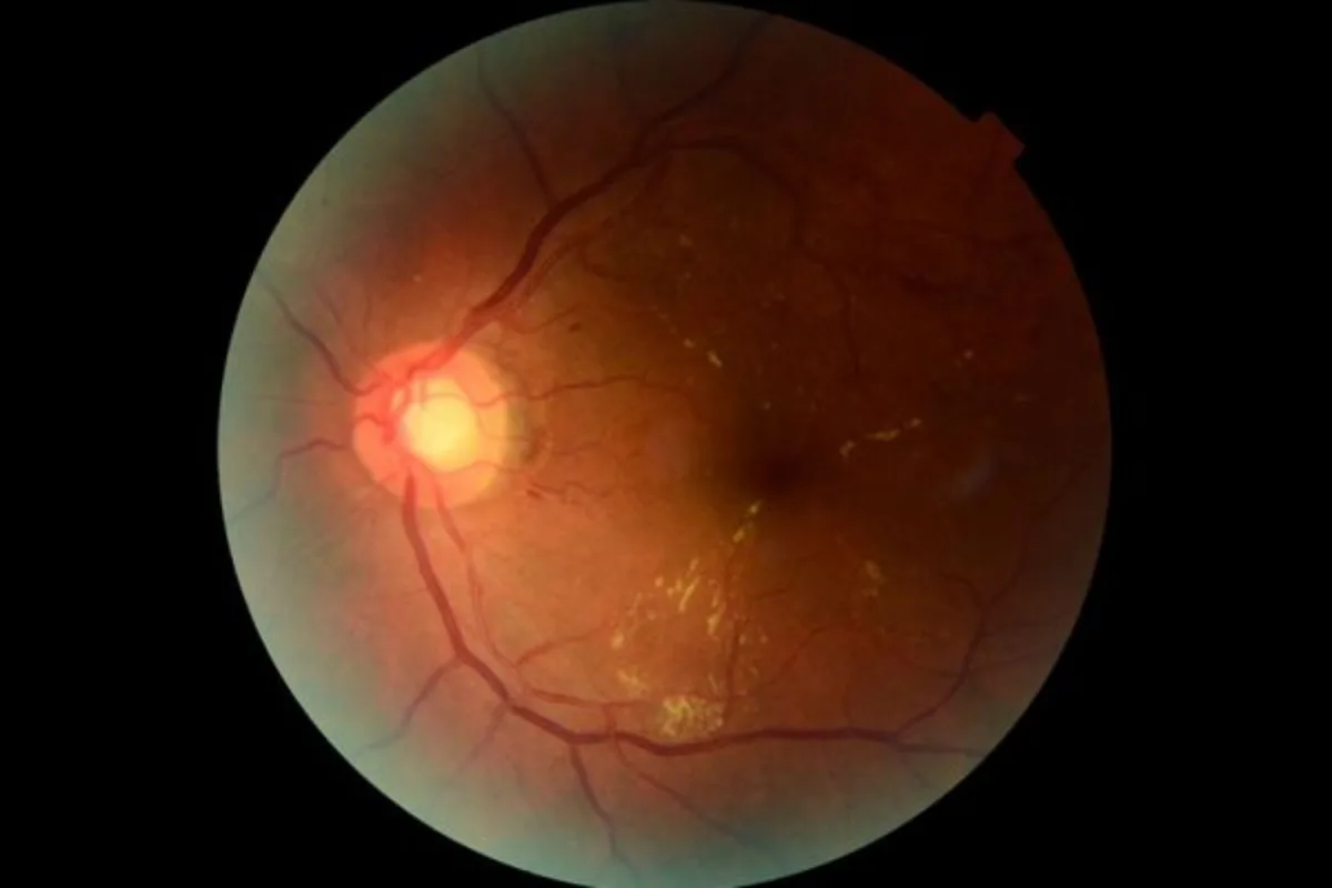 Así es la IA del Conicet que revoluciona los controles oftalmológicos: detecta a tiempo daños visuales causados por la diabetes