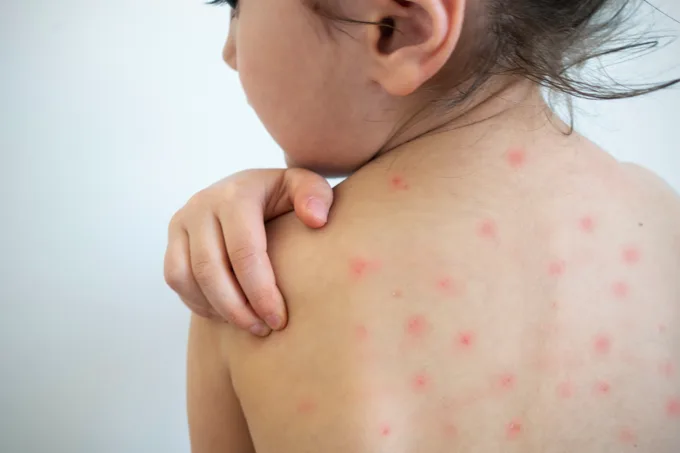 Sarampo: o que acontece quando uma geração começa a esquecer o valor da vacina