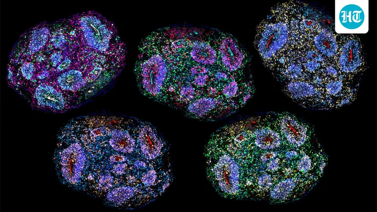 Supreme Court lens on stem cell therapy for autism