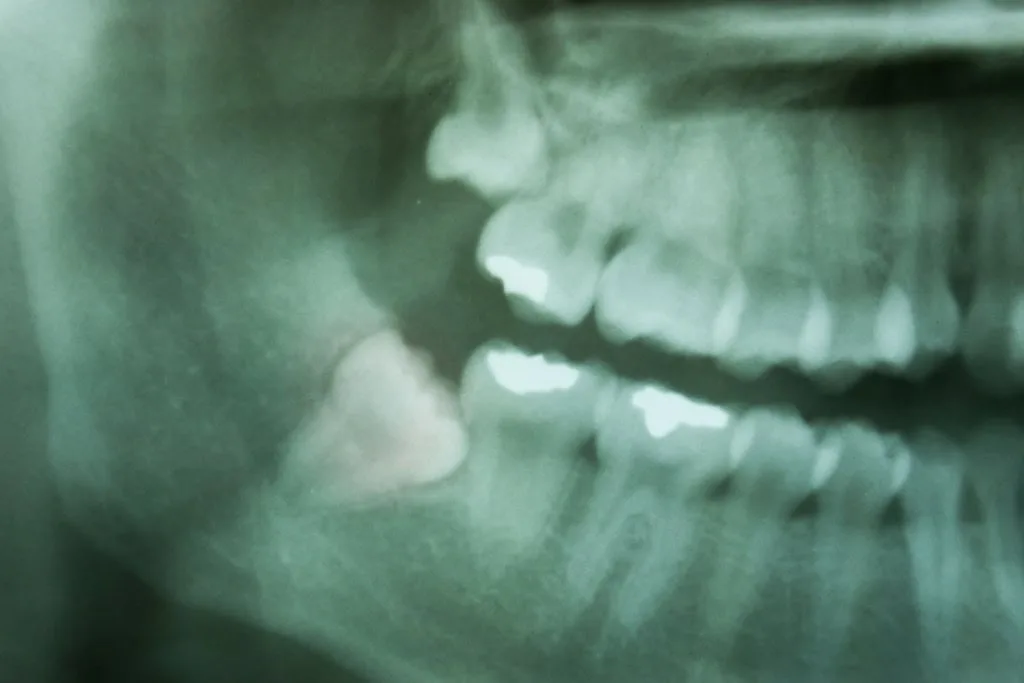 USP desenvolve IA que ajuda dentistas a detectar cáries em radiografias