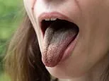 I've had a black tongue for over a year. Scraping hasn't helped and it's so unsightly. What's wrong with me? DR SCURR reveals the little-known condition that affects so many... and what it means for your health