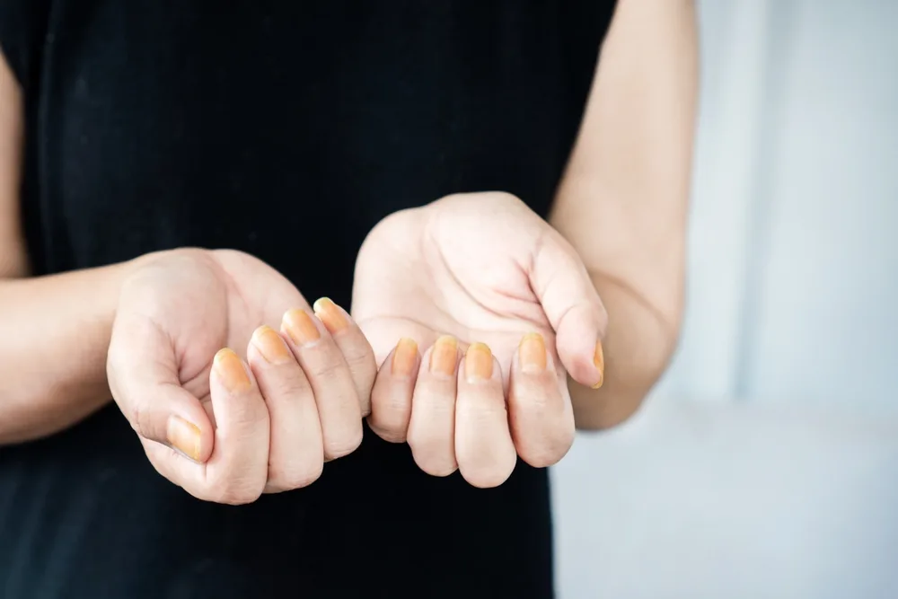 O que as unhas dizem sobre a sua saúde? Veja os sinais de alerta