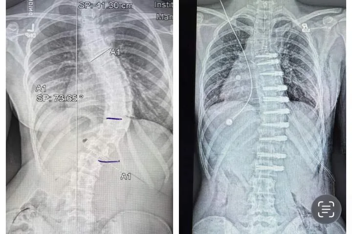 Alberta teen’s family sues government after nearly $200K out-of-country surgical bill