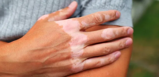 Atividade de genes virais incorporados ao genoma humano pode indicar piora do vitiligo