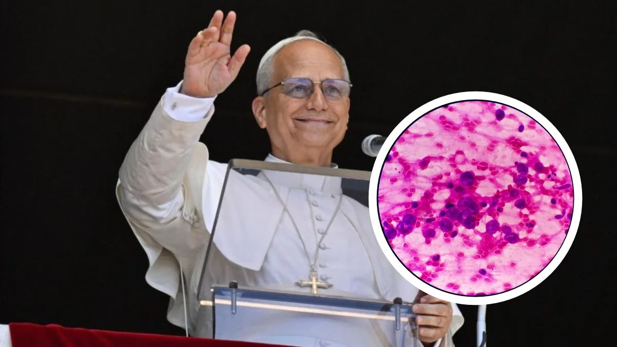 O que é adenocarcinoma pulmonar, tipo de câncer que afeta o papa Leão XIV e pode atingir pessoas que nunca fumaram
