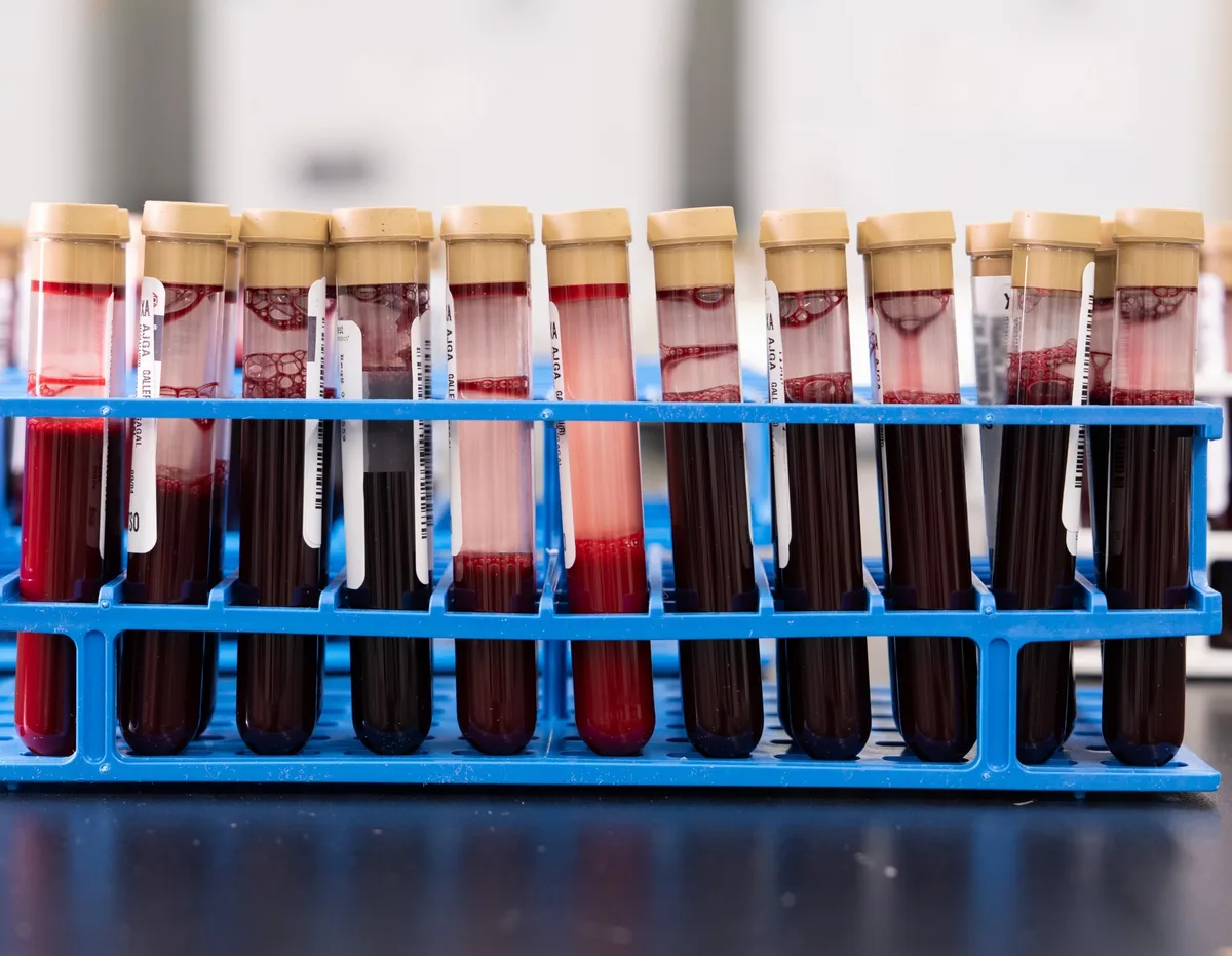 Chega ao Brasil novo exame de sangue que pode identificar 50 tipos de câncer