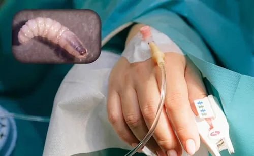 Casos de gusano barrenador en humanos se quintuplican en 2026; México suma 692 contagios en 27 estados