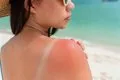 El 55% de jóvenes españoles ha sufrido quemaduras solares alguna vez pese a estar informados