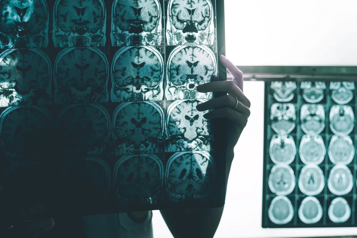 Estudo revela que células de defesa do cérebro podem ajudar a combater o Alzheimer