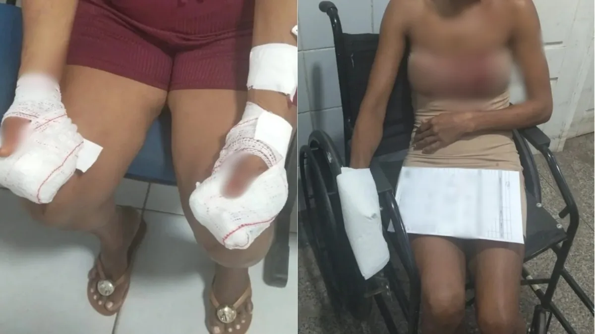 Homem é preso suspeito de agredir a mãe e a própria namorada em Codó; uma das vítimas perdeu alguns dedos
