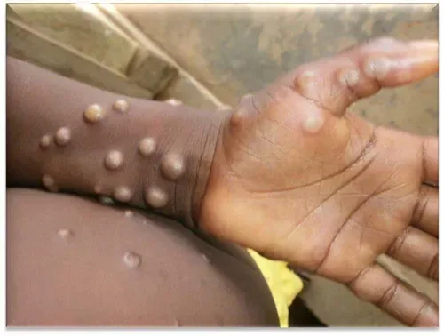 Mpox cases in South Africa rise to 26 as health authorities urge vigilance