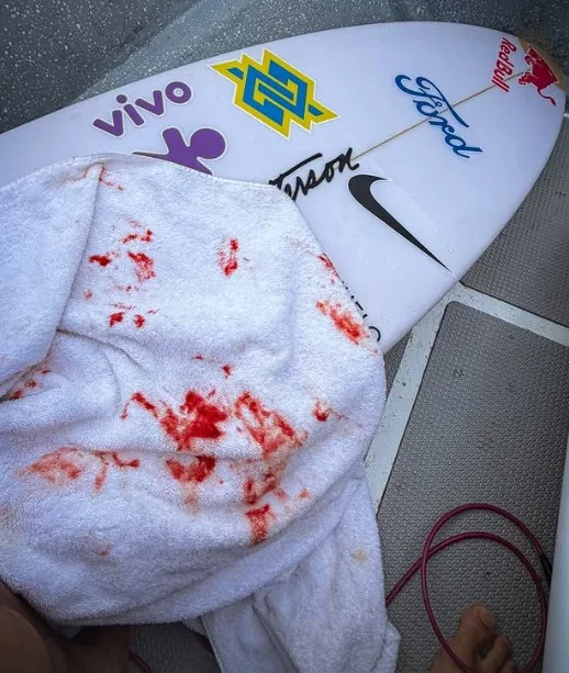 Italo Ferreira sofre acidente durante treino e leva pontos no nariz antes da etapa de Fiji