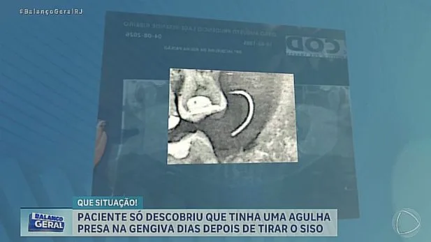 Homem extrai siso e se revolta com descoberta após passar 10 dias sem comer e beber no RJ Foto: Reprodução/Record