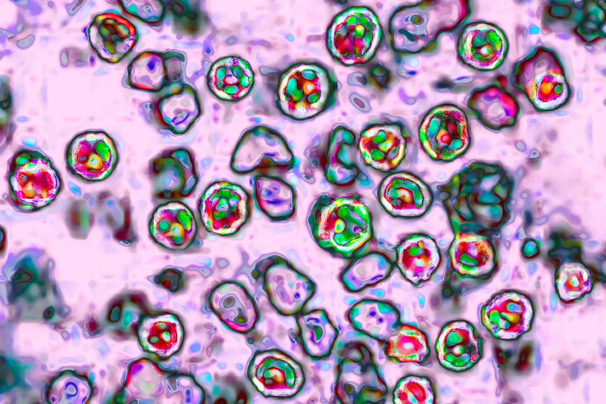 A sixth measles-related death is reported in Pennsylvania