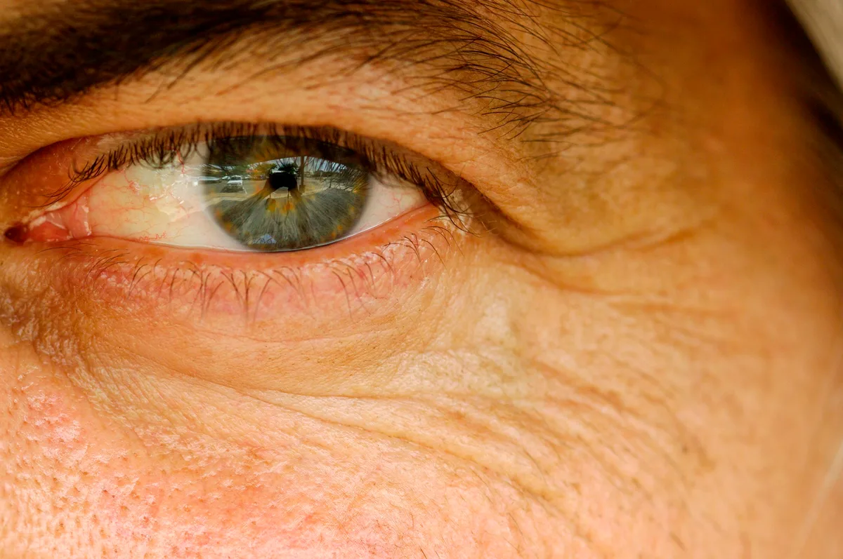 Estudo relaciona uso de tadalafila por longos períodos a maior risco de glaucoma