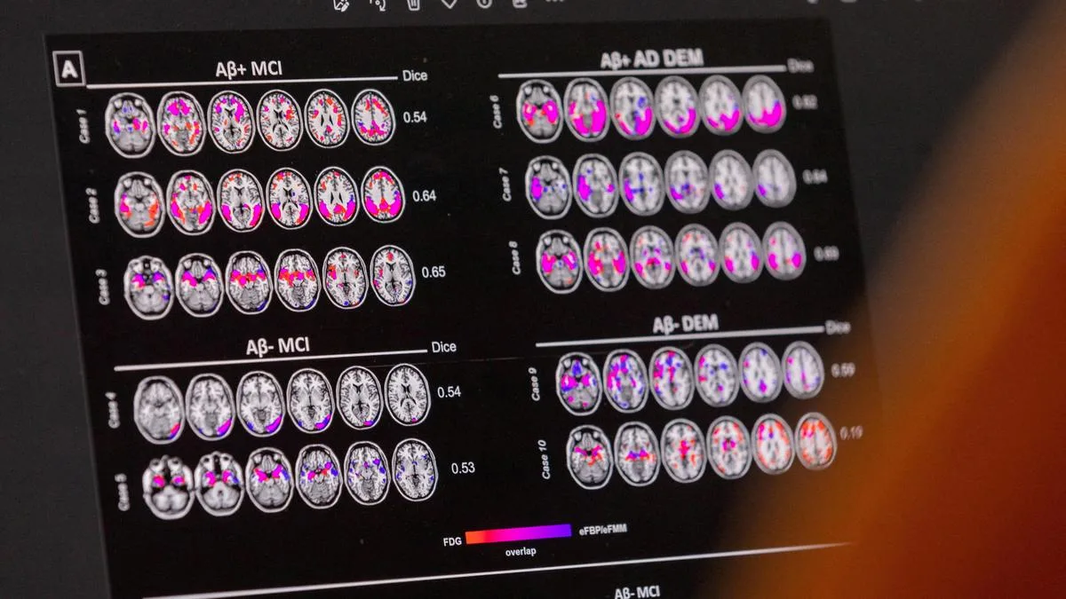 Early-onset Alzheimer's disease looks very different to late-onset version: study