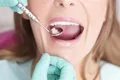 Células madre de la pulpa dental, ¿futura terapia para recuperar un ictus?