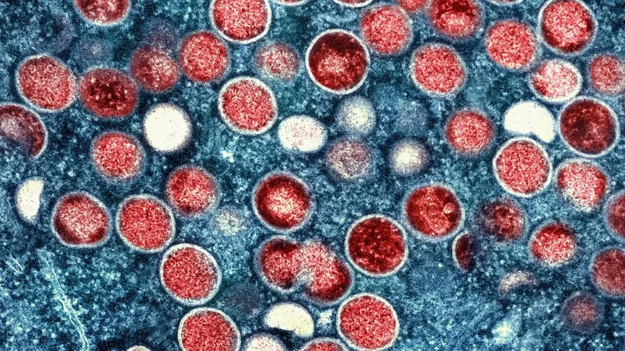 Seltene Krankheit: Mpox weitet sich in Berlin auf weitere Personengruppen aus