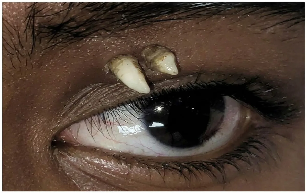 Dente cresce entre olho e sobrancelha de adolescente de 16 anos; entenda
