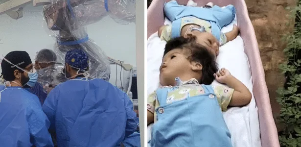 Gêmeas siamesas unidas pela cabeça morrem em cirurgia de separação em SP