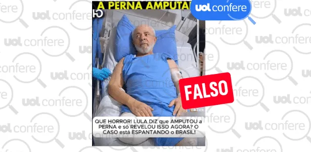 Lula não revelou que amputou a perna direita em 2023