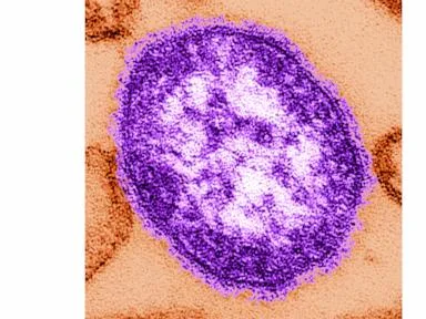 Coroner releases details of infants who died amid growing measles outbreak