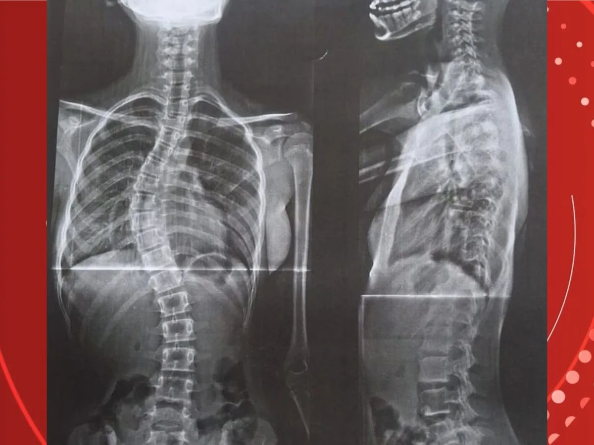 Após enfrentar o governo, mãe consegue cirurgia para filha com coluna em formato de 'S' em RO