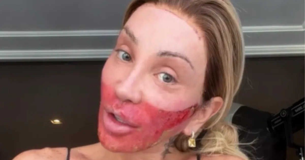 Influenciadora surge com rosto queimado e especialista alerta: 'Não é assim'