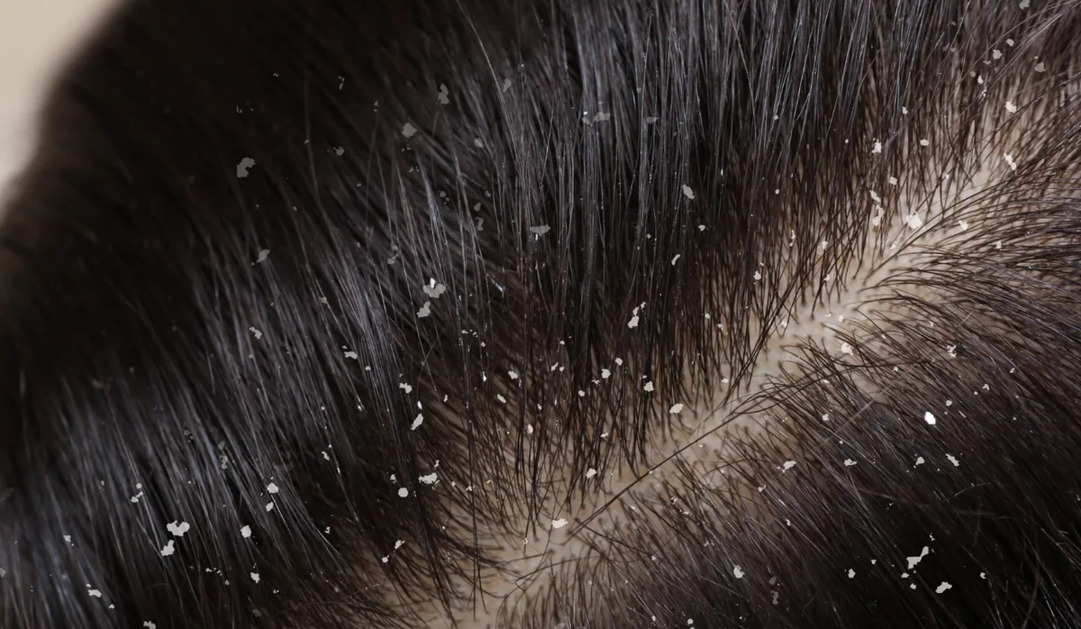 Fim da caspa: shampoo sólido promete controlar descamação e oleosidade