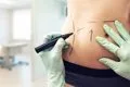 ¿La liposucción sirve para adelgazar? Los seis mitos que conviene aclarar