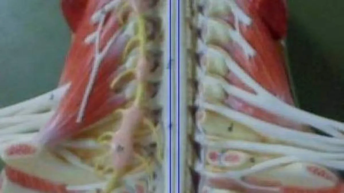Avances esperanzadores en el primer implante mundial de una médula espinal artificial en un paciente con parálisis