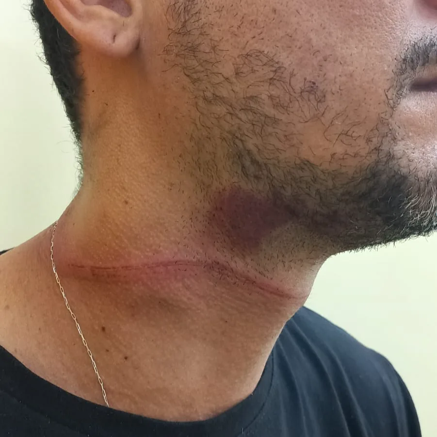 Motociclista fica ferido após ser atingido por fio solto de telefonia