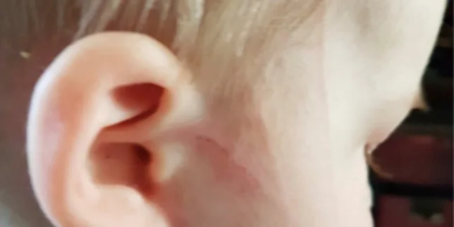 Grave épilepsie réfractaire chez un enfant : des années d’errance diagnostique après une simple griffure de chat