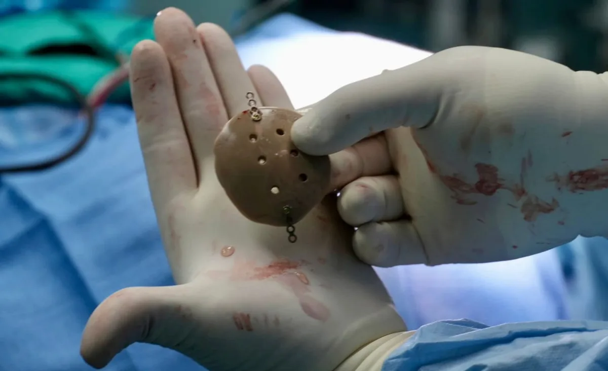 Costa Rica marca un hito médico: implanta por primera vez una prótesis craneal fabricada con impresión 3D por su sistema público de salud