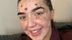 'My skin makes me unique and I'm learning to embrace it'