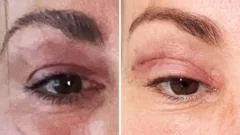 'My eyelids became infected - I was scared to sleep'
